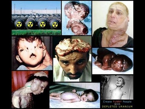 Bildquelle: eineweltdiplomaten.wordpress.com Verstrahlte Opfer durch Einsatz von Uranmantelgeschossen